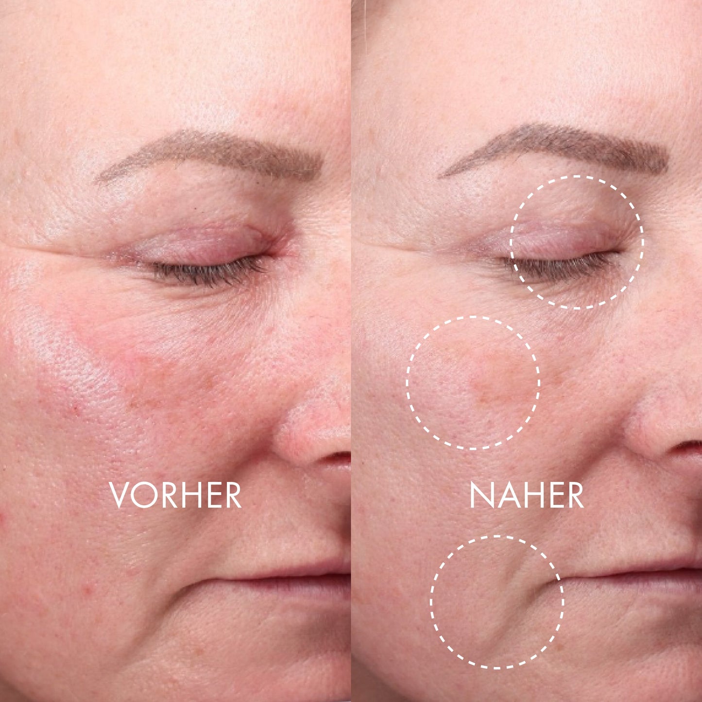 DERMA EXPERT LED Light Treatment - QMS Medicosmetics UK